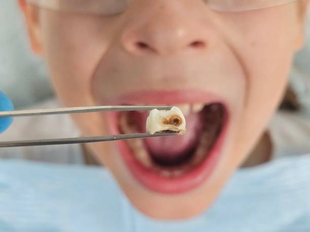 Best Emergency Dental Care for Broken or Chipped Teeth in Empire, CA
